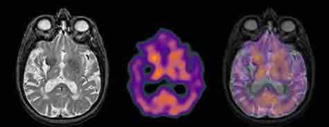 Demencia vascular: RNM y TAC.