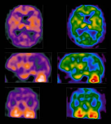 Demencia ligada a Parkinson.