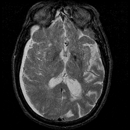 Hematoma subdural.