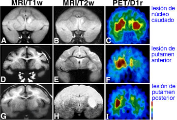 Trastornos de etiología orgánica: Demencias, Enfermedad de Parkinson,  Enfermedad de Niemann-Pick, Enfermedad de Huntington