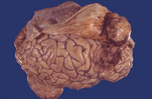 Meningioma.